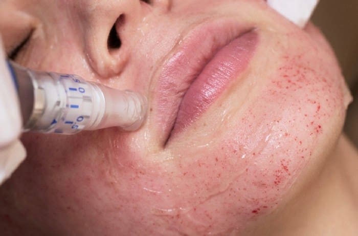 Microneedling 5069