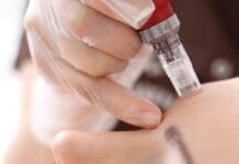 Microneedling 5070
