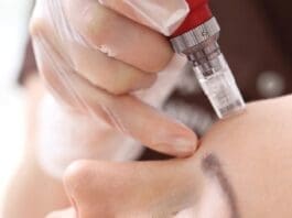 Microneedling 5070