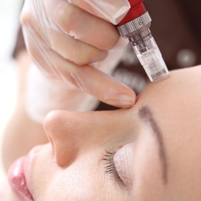 Microneedling 5070