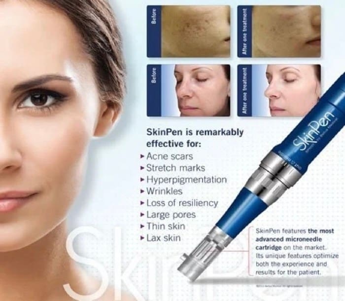 Microneedling 5072