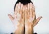 Vitiligo 5498