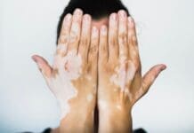 Vitiligo 5498