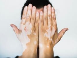 Vitiligo 5498