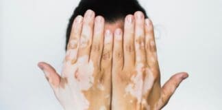 Vitiligo 5498