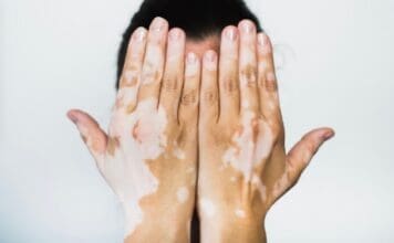 Vitiligo 5498