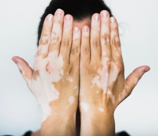 Vitiligo 5498