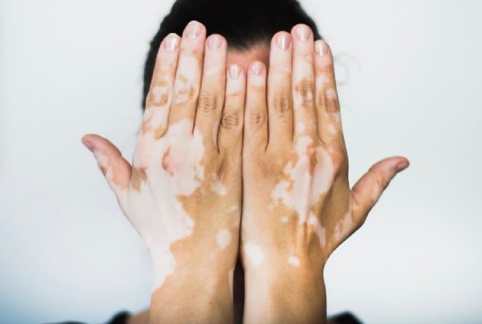 Vitiligo 5498
