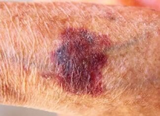 The Unsightly Medical Condition: Actinic Purpura Coastal Skin Surgery 6641