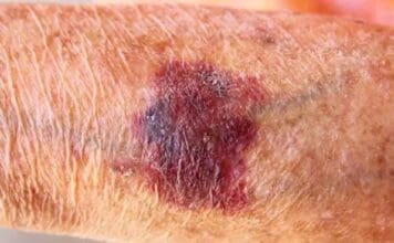 The Unsightly Medical Condition: Actinic Purpura Coastal Skin Surgery 6641