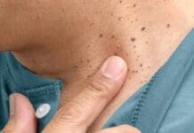 Coastal Skin Surgery Skin Tags