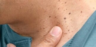 Coastal Skin Surgery Skin Tags