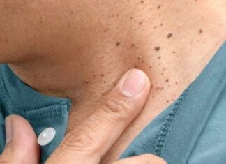 Coastal Skin Surgery Skin Tags