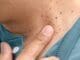 Coastal Skin Surgery Skin Tags