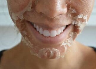 Consider a Chemical Peel Before Summertime Arrives Img 9133