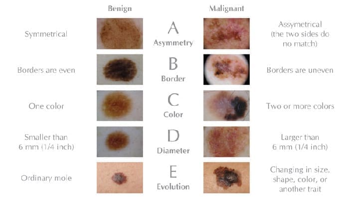 Melanoma 0151